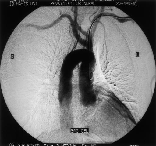lu hastan n toraks bilgisayarl tomografisinde arkus aortan n sa yerleflimli oldu u görülmektedir. SA/SAA). Ayna hayali sa arkus aortada ilk dal sol brakiyosefalik arterdir.