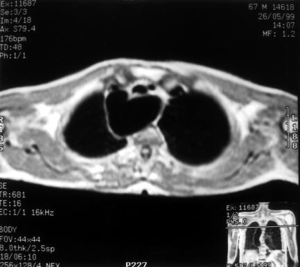 Konjenital kalp hastal bulunmayan hastalarda en s k görülen arkus aorta anomalisi ASSA/SAA d r.