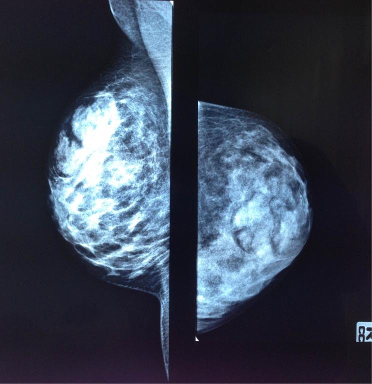 A 16- year-old female patient attended to our outpatient clinic suffering from a palpable mass at her right breast for 4 months. She had no family history.