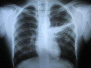 Akciğer Tüberkülozu Primer tüberkülozda bazı