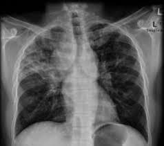Tanıda akciğer radyolojisinin yeri: Reaktivasyon