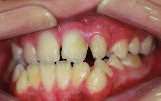 6 Yüksek ve orta risk gruplarında yapılacak dental müdahaleler derin dentin çürüğü tedavisini geçmemelidir.