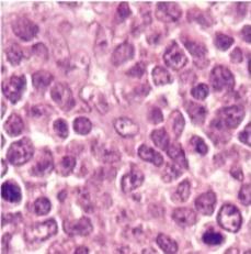 lymphoma Germinal center B-cell like diffuse large B-cell