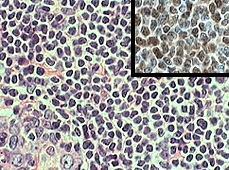 tedavilerle inkürabl CD19+, CD5+, CD23- t(11;14)