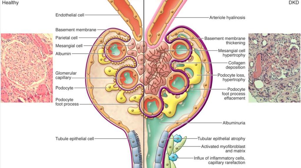 Diyabetik Nefropatide Patolojik Lezyonlar