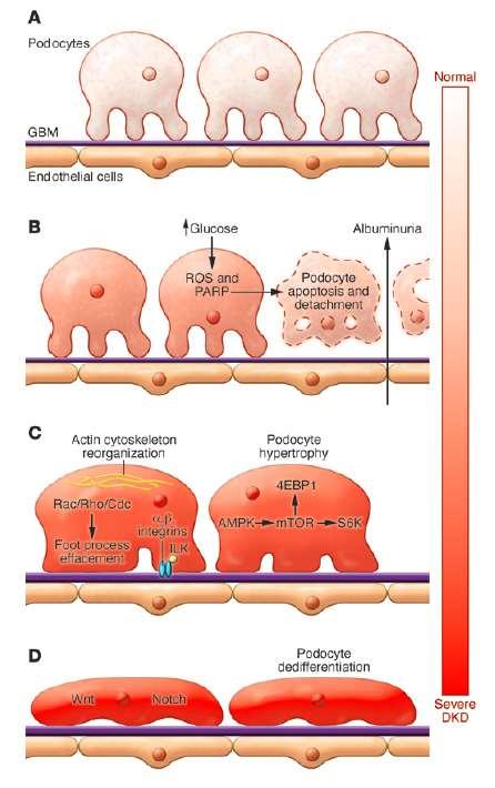 Diyabetik Nefropatide Podositlerin Rolü Reidy