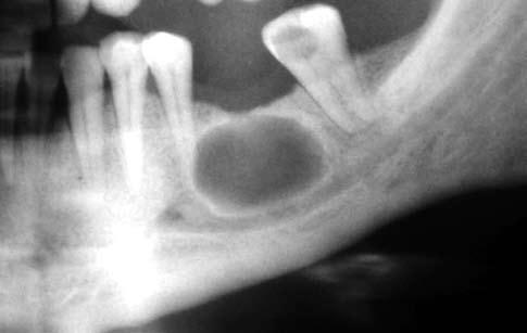 saptandı. Birer olguda ise gingiva kisti, nazopalatin kist, rezidüel kist (Şekil 5) ve median mandibula kisti (Şekil 6) görüldü.