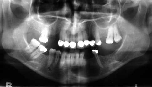 Yirmi dört yaşındaki bir erkek hastada, mandibula ramus yerleşimli, multiloküle kavitesi bulunan ve kortikal perforasyona neden olmuş keratokist, agresif küretajlara rağmen iki kez nüks etti.