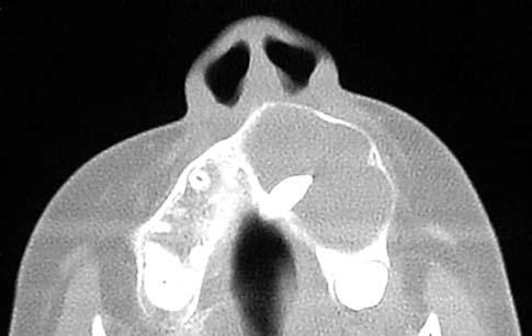 Şekil 11. Yedi yaşındaki hastada maksiller bölge yerleşimli dentigeröz kistin bilgisayarlı tomografi görüntüsü.