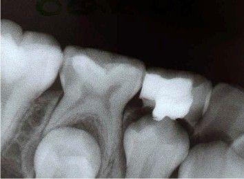 olarak eksfoliye olmuştur (Resim 3.3). Resim 3.3. Ferrik sülfat amputasyonu yapılan dişte internal rezorpsiyon bulgusu gözlendi.