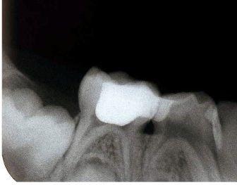 KH grubunda üçüncü ve altıncı aylarda internal rezorpsiyon bulgusu kaydedilen üç dişte ilerleyen aylarda furkasyonda