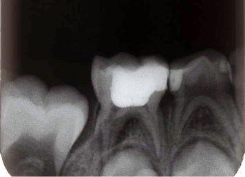 İnternal rezorpsiyon ve furkasyonda radyolusensi bulgusu gözlenen dişlerden birinde dentin bariyeri oluşumuna da rastlandı