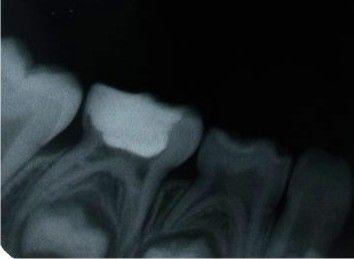 Resim 3.5 Kalsiyum hidroksit amputasyonundan sonra altıncı ayda dentin bariyeri oluşan bir dişte 18.