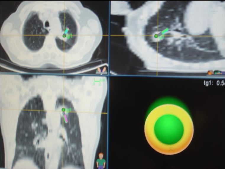 Navigasyon bronkoskopi birkaç basamakta gerçekleştirilir. Yaklaşık 1mm boyutlarında ince kesitlerin olduğu bir Spiral BT bilgisi gereklidir (6).