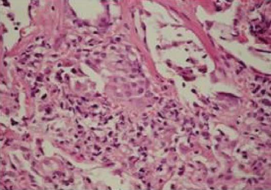 TBB kesitlerinde, intersitisyel alanda granülom benzeri histiosit birikimi ve tip II pnömosit proliferasyonu (H-E x 400) TARTIfiMA Hipersensitivite pnömonisi, çeflitli antijenlerle tekrarlayan karfl