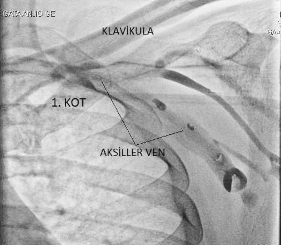 Yalçın GÖKOĞLAN ve ark. İMPLANTE EDİLEBİLEN KARDİYAK ELEKTRONİK CİHAZLAR... Subklavian ven girişim açısından kolay bir bölgededir ve sıklıkla kullanılmaktadır.