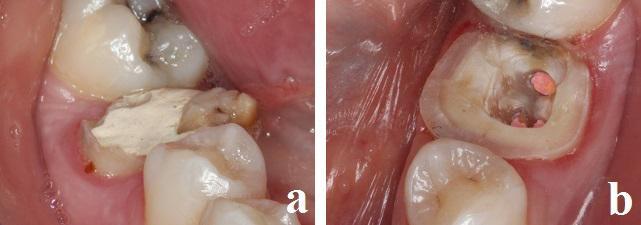 endodontik tedavisi tamamlanan dişte herhangi bir mobilite veya apikal lezyon gözlenmemiştir (Resim 1a).