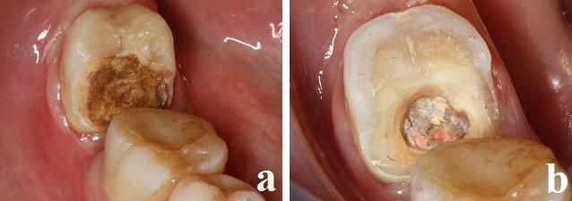 Yüzey hazırlığı yapılan endokron restorasyonu, üretici talimatları doğrultusunda self-adeziv rezin siman (RelyX U200, 3M Espe, Almanya; Lot numarası: 545768, Renk: A2) ile aynı seansta simante