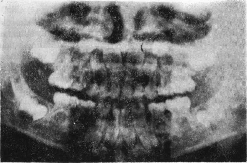 Peruze ÇELENK Resim 6 d. Aynı olgunun panoramik radyografideki görünümü. Daimi lateral dişlerin eksik olduğu görülmektedir.