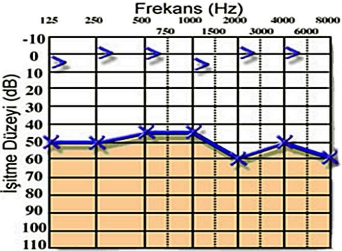 İLETİM TİPİ İŞİTME KAYBI İTİK Kemik Yolu 20 db Altı