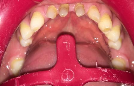 Olguda mandibular diģlerin görünümü. Resim 6: 1.