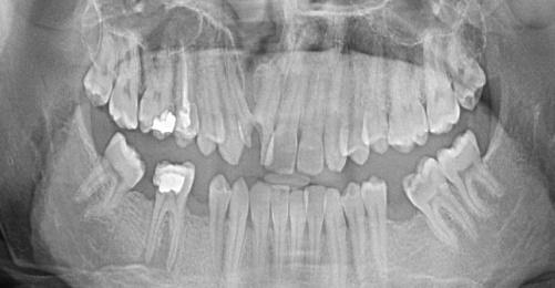 Dicle Dişhekimliği Dergisi / Dental Journal of Dicle Cleft Lip And Palate Alper İLKER ve ark. (2). Japanese population has the highest prevalence (19.