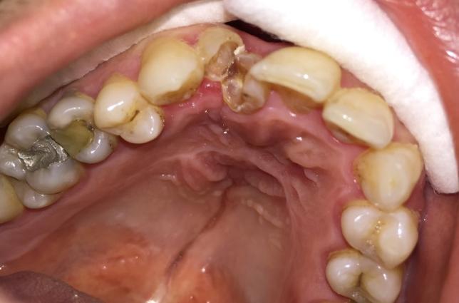 A wide radiolucent area was seen in radiographic examination, at the right side of maxillary jaw due to previous CLP surgery (between teeth 11, 12).