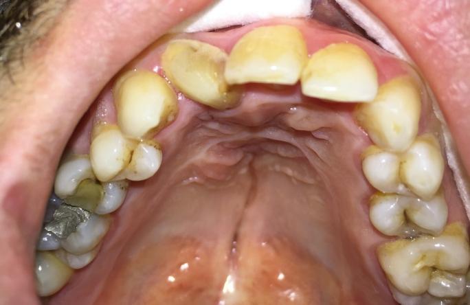 Dicle Dişhekimliği Dergisi / Dental Journal of Dicle Cleft Lip And Palate Alper İLKER ve ark. Glidden instrument (Dentsply Maillefer, Ballaigues, Switzerland).