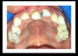 Resim 8. Üst çene intraoral görünümü Resim 6.