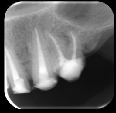 clinical crown lengthening(4).