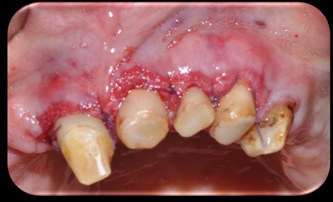 Dicle Dişhekimliği Dergisi / Dental Journal of Dicle Osteoplasty and Apically Positioned Flap Technique Mustafa Özay USLU ve ark.