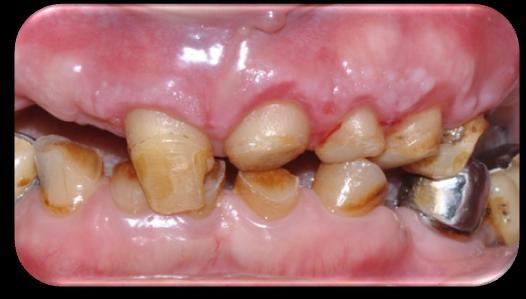 Figure 3: Operation time Operation area covered with Coe-Pak (GC America Inc,IL,ABD). Patient was prescribed anti-inflammatory drug and chlorhexidine after operation. No complications were observed.