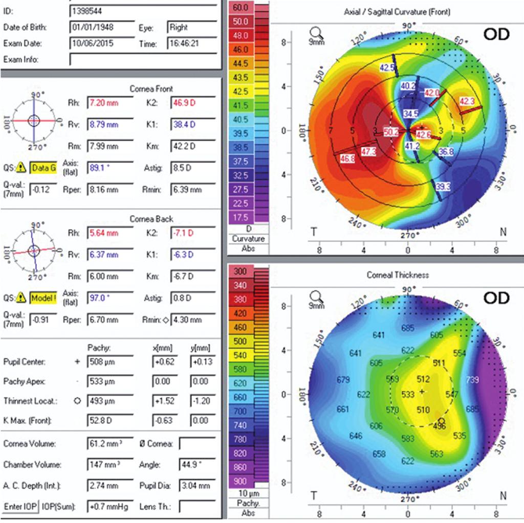 Gözde KOÇAK ve ark. Turkiye Klinikleri J Ophthalmol 2017;26(4):297-303 RESİM 3: Cerrahi sonrası 12. ayda kornea topografisi.