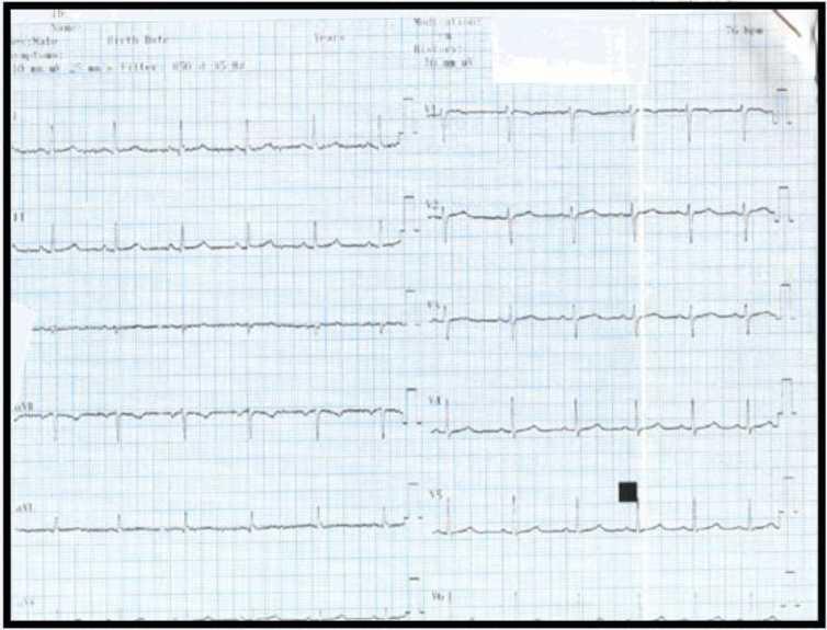 Şekil-17 Nihon Kohden Cardiofax M 1350 K (Nihon Kohden Corporation Tokyo, Japan) EKG Cihazı Çıktısı Her iki elektrokardiyografi cihazının çıktıları alındıktan sonrasında hastanın mevcut klinik takibi