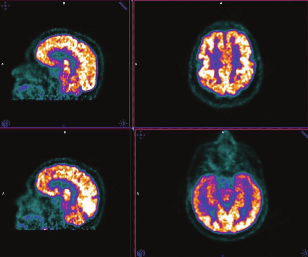 147 Nucl Med Semin 2016;3:144-152 Sürer Budak ve Aydın, Demansta Nükleer Tıp Yöntemleri posterior singulat korteks/prekuneus rölatif olarak daha yoğun FDG tutulumu göstermektedir (7).