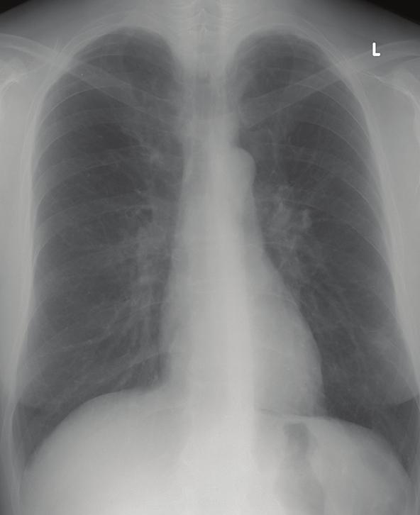 Rolston [4] ve arkadaşlarının 2098 hastada yaptığı bir retrospektif çalışmada akciğer kanseri nedeniyle araştırılan hastaların %1,3 ünde infeksiyon hastalıkları tespit edilmiştir.