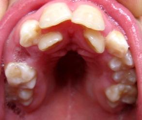 Hipotonik dil damak kubbesinin şekillenmesini etkilemezken, lingual diastaza bağlı olarak damak basamak şeklini alabilir (91) (Resim 14).