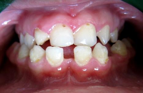 Garn ve ark., daimi dişlerdeki ortalama kron boyut azalmasını %8,7 olarak bulmuşlardır. Diş boyutundaki azalma en fazla maksiller 2. molar, lateral kesici ve kanin dişlerde görülmüştür (38). b.) Konjenital diş eksikliği: Down sendromlu bireylerde (%50 oranında), genel popülasyona (%2 oranında) oranla daha sık görülür.