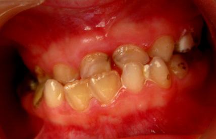 disfonksiyonu, sürme gecikmesi, dil itimi, hipotonik mandibular eklem ligamenti,