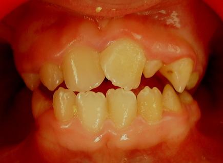 Dilin hipotonik olması ve yetersiz lateral dil hareketleri, oromotor fonksiyonların değişmesine yol açar. Yeni doğanda minimal olan dental ark farklılığı, yaşla birlikte değişim gösterir.