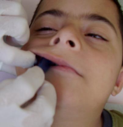 Resim 37-38: IOPI cihazı ile dudak kuvvetinin ölçülmesi Dil ve dudak kas kuvvetinin belirlenebilmesi amacıyla, çalışma grubu hastalarında tedavi başlangıcı ve tedavi