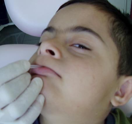 Oral Bölge Egzersizleri ve Ses Egzersizleri Hastaya uygulanacak tedavi şeklini belirlemek ve oral bölge kaslarını kuvvetlendirmek amacıyla, hastalara oral bölge ve ses