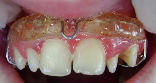 Resim 57: Üst dudağı uyaran akrilik yastıkçıklar Süt dişleri sürdükçe plak üzerinde dişler için uygun