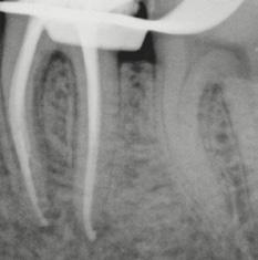 SERİ ORIFICE OPENER (isteğe bağlı) 25 /.12 Glidepath Eğesi 10 /.05 Hazırlık dosyası 20 /.