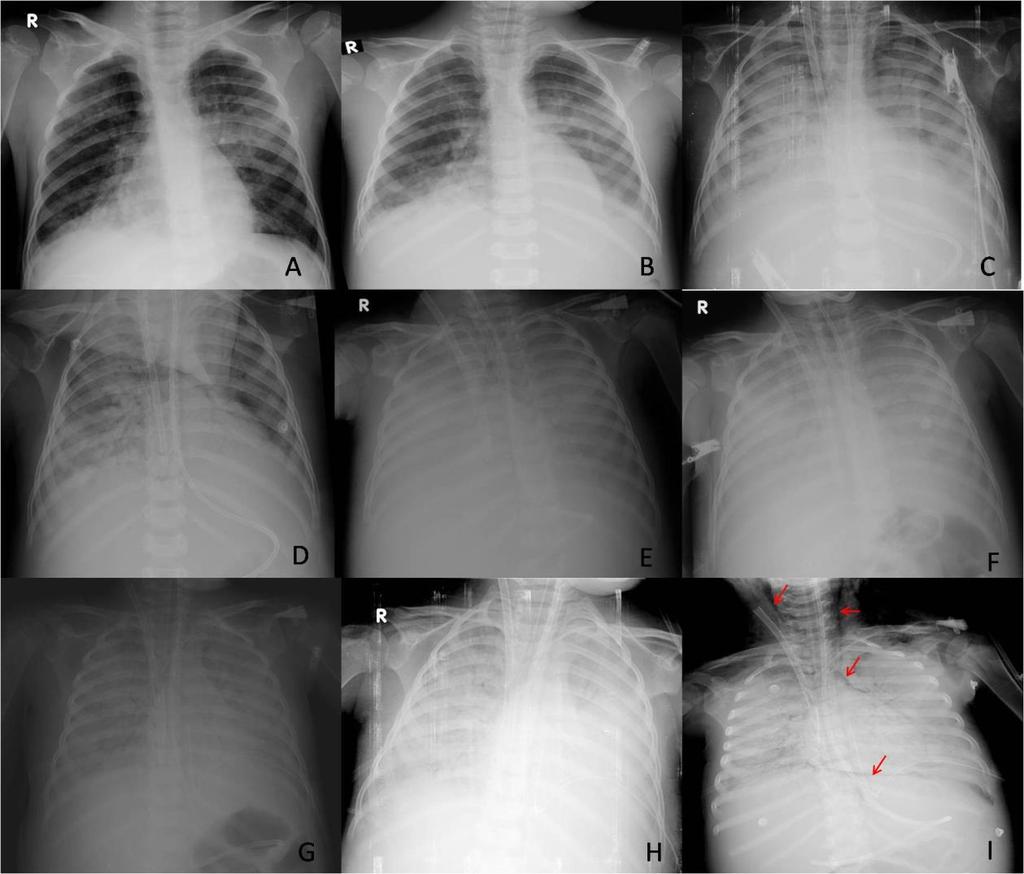 Resim 1. Hastanın çocuk yoğun bakım birimindeki yatışındaki günlük akciğer grafileri. A. Çocuk yoğun bakım birimine yatışındaki ilk akciğer grafisi. B. İkinci gün. C. Üçüncü gün (Birinci ECMO günü).