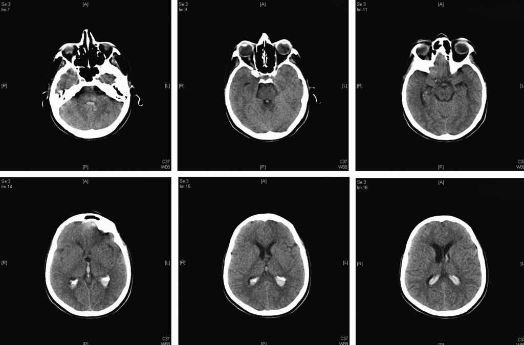 Şekil 1: Kraniyal BT de her iki lateral ventrikül, 3. ve 4. Ventrikülde kanla uyumlu hiperdens görünüm mevcut. Şekil 2: MR anjiyografide anterior komminikan anevrizması görülmektedir.