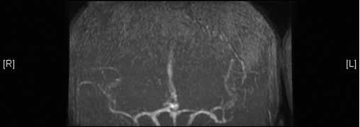 Büyük kısmı BBT de subaraknoidal kanama (SAK) olarak karşımıza çıkmakla birlikte intraparankimal hematom (IPH), intraventriküler kanama (IVH) ve subdural hematom da eşlik edebilmektedir.