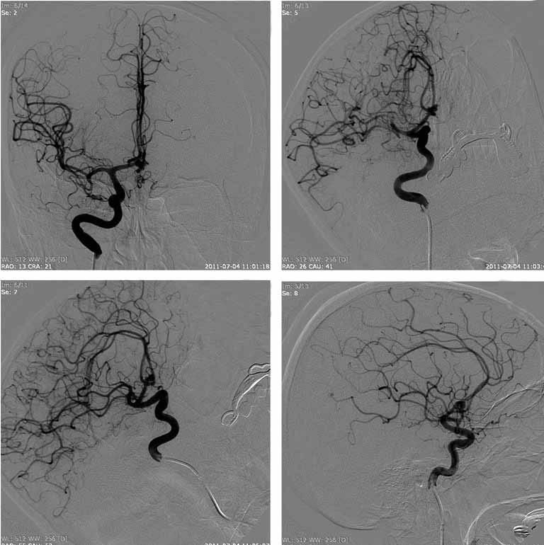 Şekil 3: Serebral DSA da lobule anterior