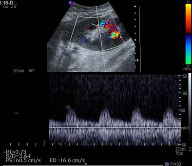 A. B. Resim 16 A-B: 21 yaşında kadın hastada sol iliak fossada transplant böbrekte dupleks Doppler incelemede yüksek rezistanslı akım örnekleri (A, B).