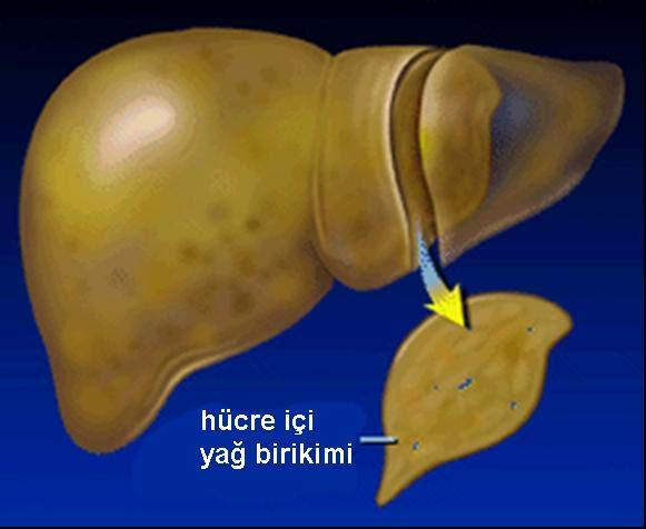 Alkolik karaciğer hastalığı Transaminaz düzeyleri nadiren >300 IU/dl AST artışı >